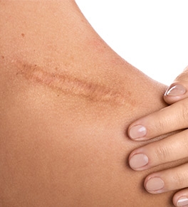 4 Types of Scars and How to Minimize Them