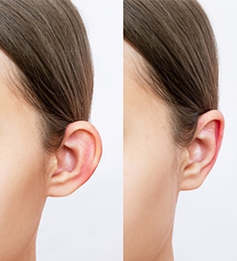 What is Involved in Ear Reduction Surgery?