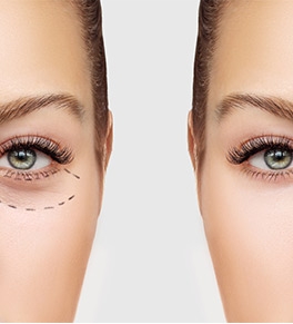 What to Expect After Your Blepharoplasty
